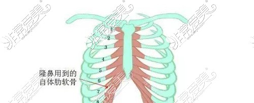 肋骨隆鼻用到的肋骨示意图