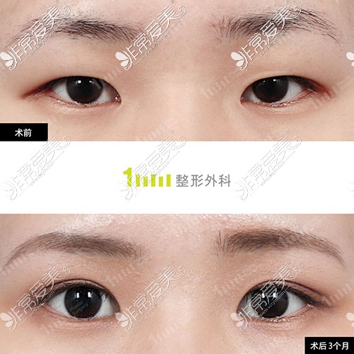 韩国一毫米整形双眼皮手术图