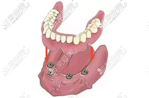 all-on-4种植牙