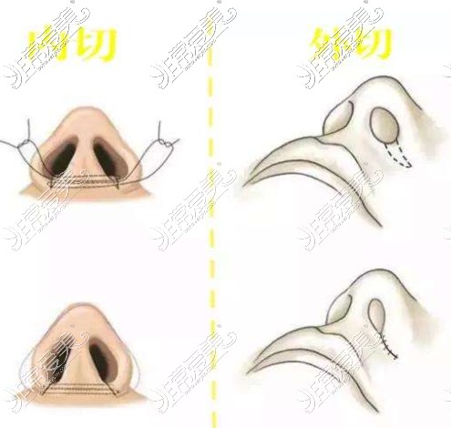 鼻翼缩小手术方式图