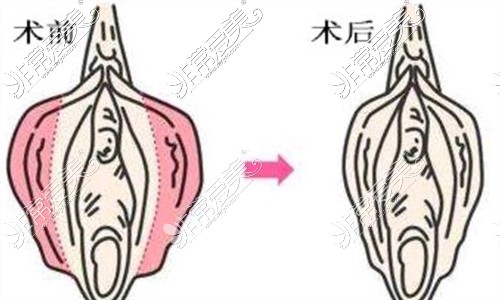 合肥小阴唇肥大整形多少钱 哪家医院医生技术好还正规