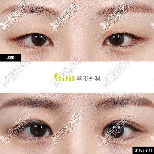 韩国1mm整形双眼皮手术图片