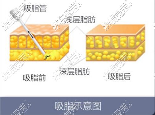 吸脂示意圖