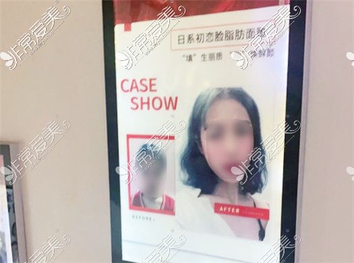 北京华韩医疗美容医院面部脂肪填充真人照片