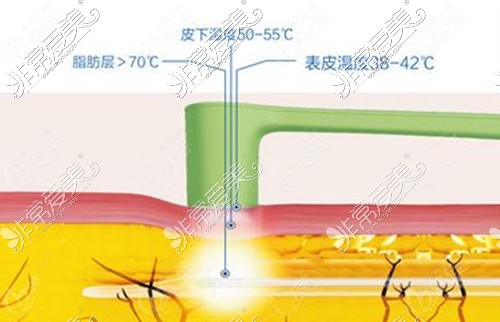 黄金微雕溶脂原理