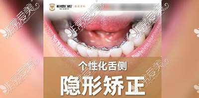 广州柏德口腔舌侧正畸