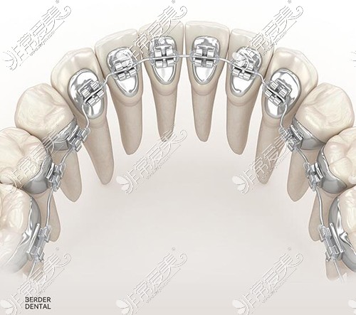 廣州柏德口腔舌側(cè)正畸材料