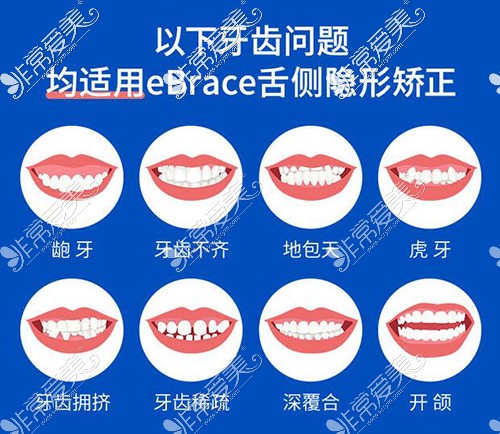 eBrace舌側(cè)適合類型