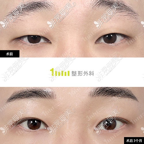 韩国一毫米整形手术双眼皮照片