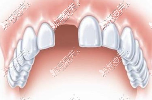 门牙缺失示意图