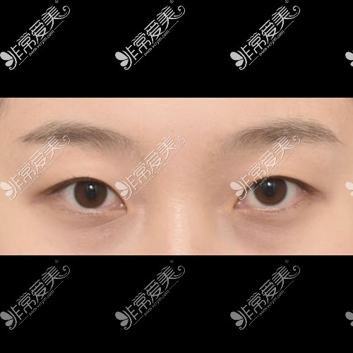 韩国icon整形双眼皮术前照