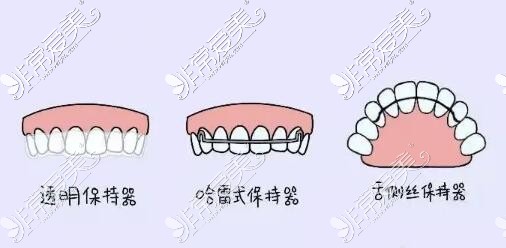 正畸后保持器不同類型