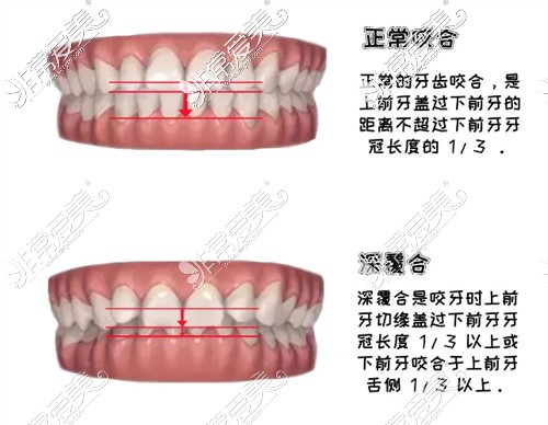 牙齿深覆合示意图