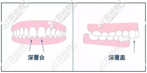 牙齿深覆合与深覆盖示意图