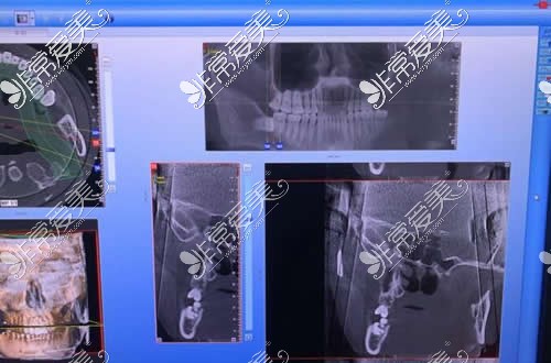 深圳朗朗口腔牙齿治疗CT照片