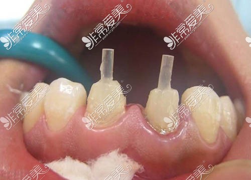牙齿治疗图片