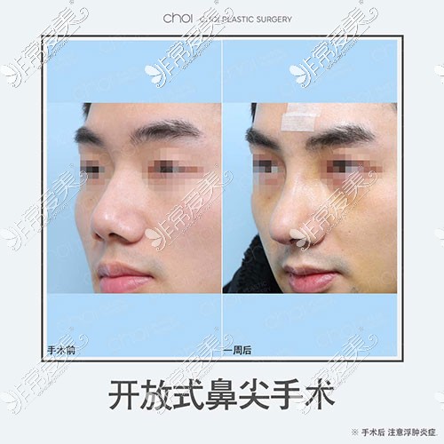 韩国icon整形鼻尖手术对比照