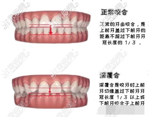 正常咬合跟深覆合對比示意圖