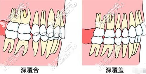 深覆合与深覆盖示意图