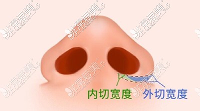 鼻翼切除宽度展示图