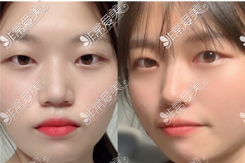 韩国双眼皮改单眼皮图片有多绝,韩国眼睛修复医生居然是他