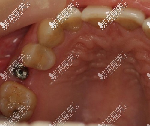 种植牙一期结束后图片
