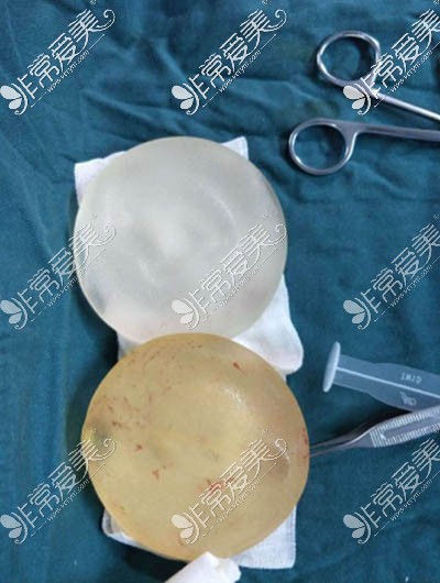 隆胸手术取出来的假体照片