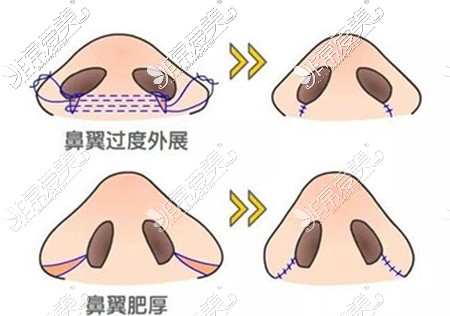 鼻翼改善治疗展示图