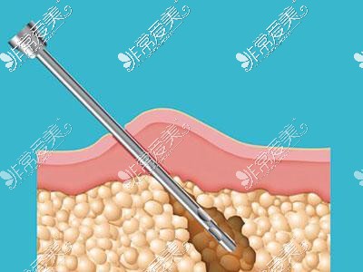 吸脂漫画图示意图