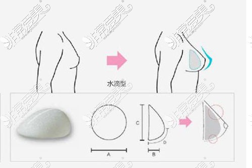 隆胸手术示意图