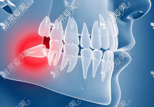 智齿疼痛示意图