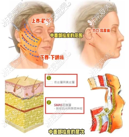 拉皮手术切口展示