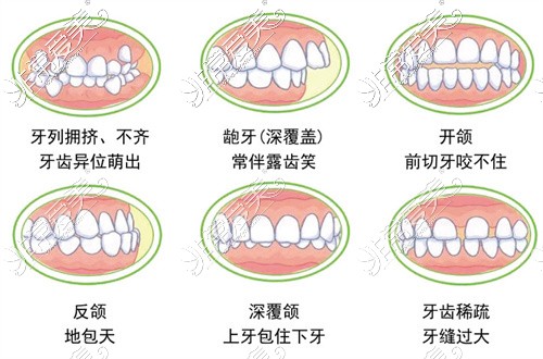 牙齿歪斜示意图