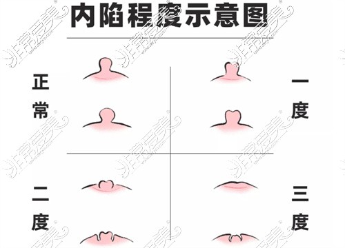 乳頭內(nèi)陷程度示意圖