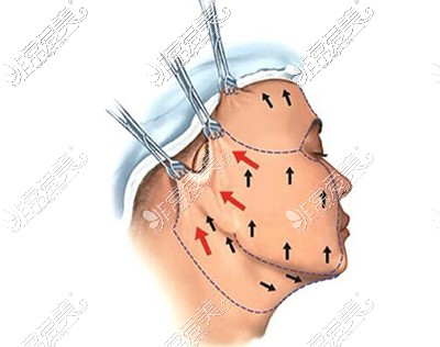 面部拉皮手术展示图