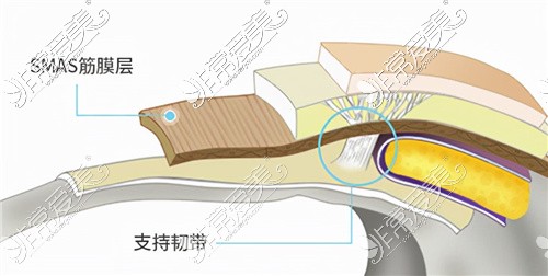 穆寶安院長(zhǎng)拉皮在支持韌帶下方操作