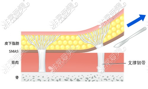 一般拉皮在筋膜層解剖
