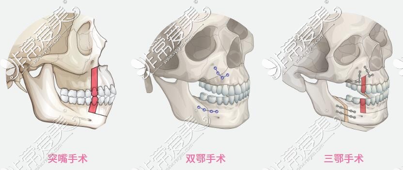 正颌改善治疗手术材料图