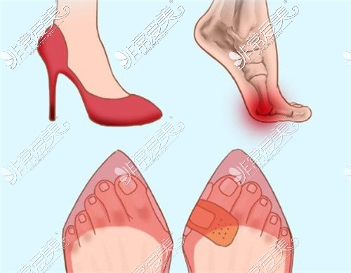 高跟鞋导致脚趾骨变形图片