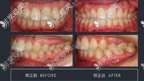 牙齿正畸照片对比