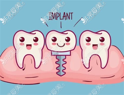 种植牙卡通图