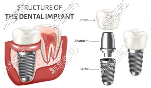 种植体结构图