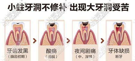 补牙改善治疗展示照片