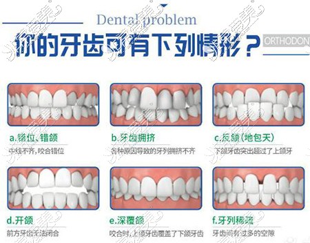 哪些牙齿要做正畸改善治疗