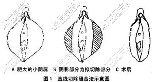 对于苏州女性私密紧缩术多少钱?私密整形价格和医院这都有