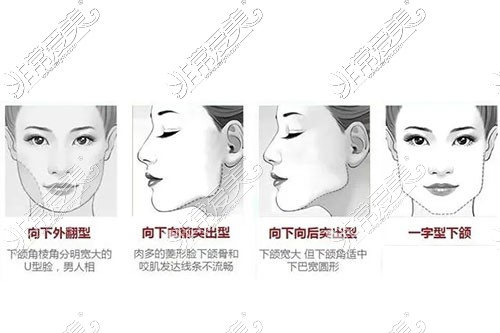 下颌骨类型示意图