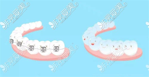 广安牙科牙齿矫正示意图