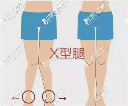 X型腿示意图