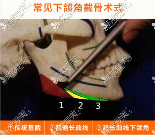 不同下頜角整形術(shù)式