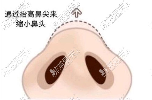 杭州瑞丽医疗美容鼻整形